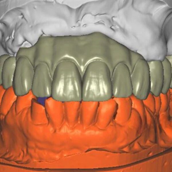 Professional full anatomy bridge design CAD file showing precise margin fit and optimal contours